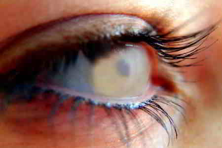 Vision 100 Augenarzt Behandlung Grüner Star